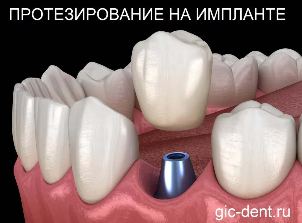 Протезирование импланта зуба в клиниках Немецкого Имплантологического Центра имеет ряд своих преимуществ